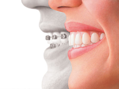 invisalign braces North Miami
