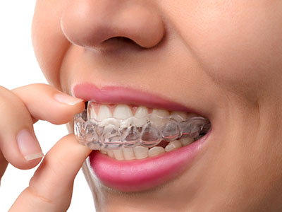 33181 invisalign